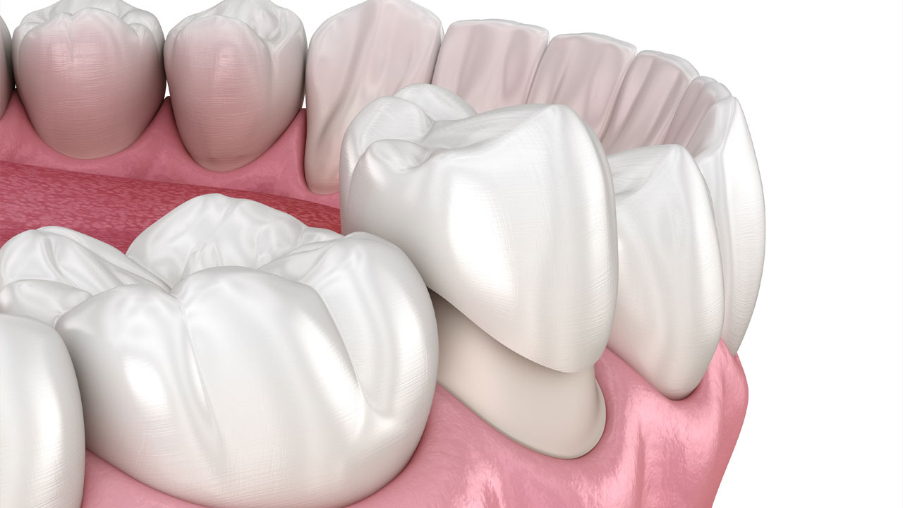 How a General Dentist Uses Crowns to Repair Teeth